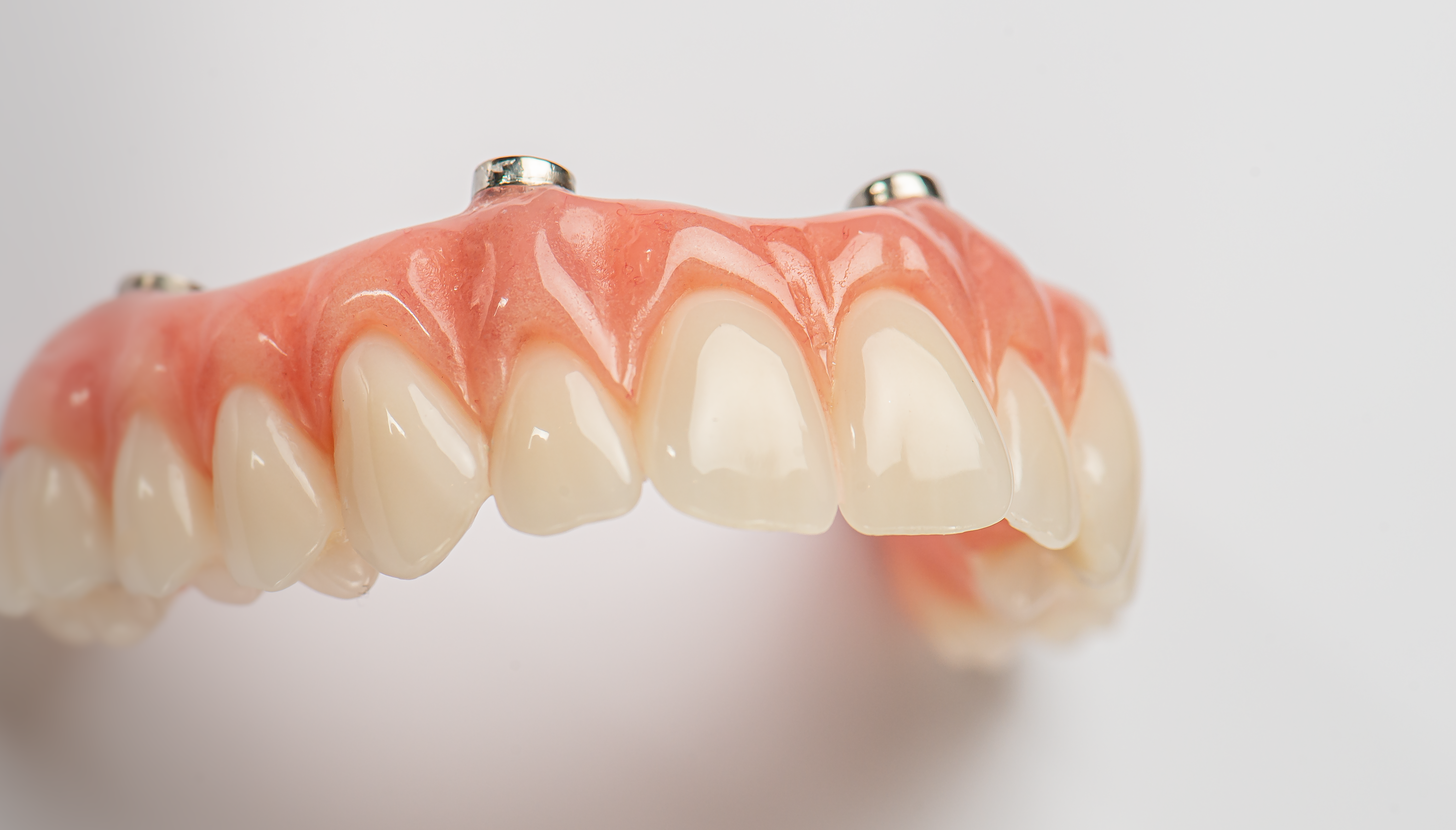 Full-arch implant prosthesis